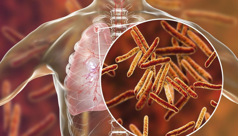 Tuberculosis: advierten un preocupante aumento de casos en niños por diagnósticos tardíos en adultos