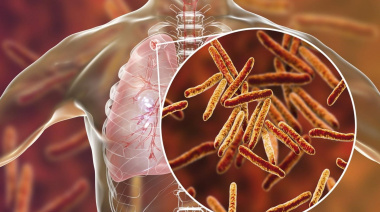 Tuberculosis: advierten un preocupante aumento de casos en niños por diagnósticos tardíos en adultos
