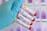 Las infecciones de transmisión sexual encabezan los contagios detectados en Junín